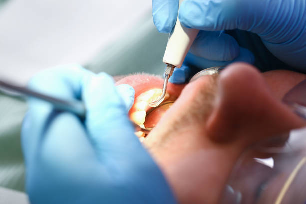 Best Emergency Dentist for Lost Fillings or Crowns in Drexel, NC