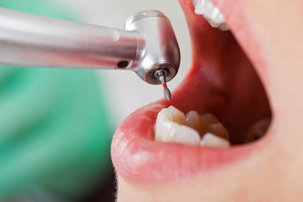 Best Emergency Dentist for Lost Fillings or Crowns in Drexel, NC